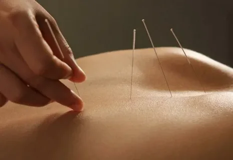 Exploring Traditional and Modern Acupuncture Techniques in Sydney